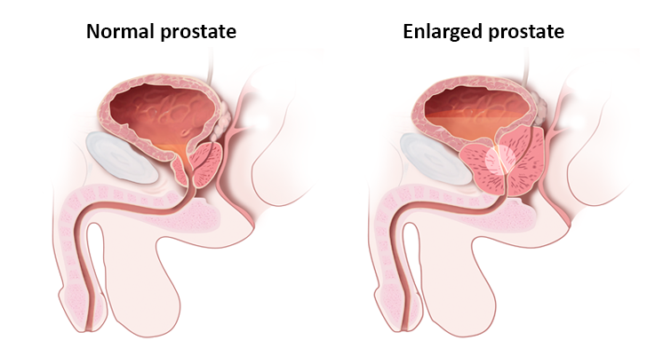 difference between prostate and bowel cancer